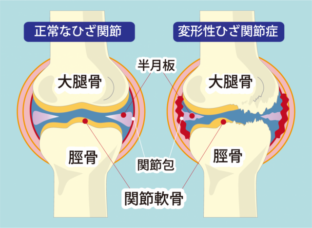 変形性膝関節症とはどんなもの?
