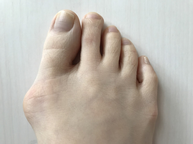 外反母趾とはどんなもの?